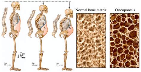 old black women fucking|Osteoporosis